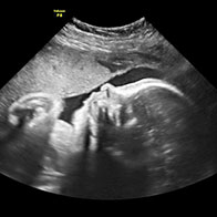 My Secret Place 2D Bonding Scan